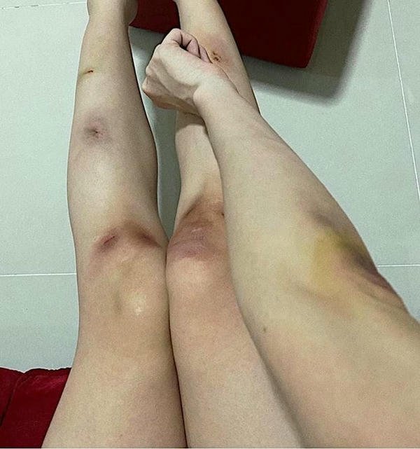 ảnh té xe hoa